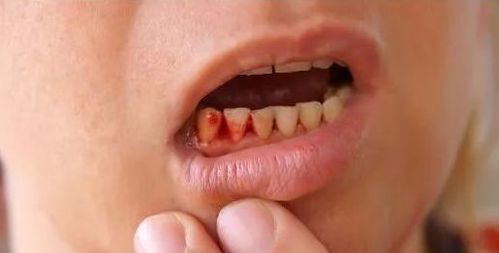 为什么戒烟后牙龈出血贴吧,戒烟后为什么牙龈老是出血 为什么戒烟后牙龈出血贴吧 第1张